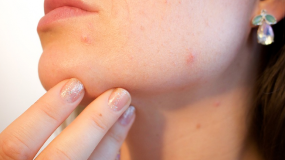 Cuidados de la cara para eliminar el acné