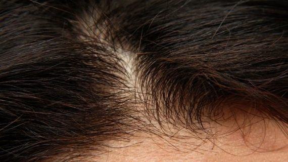 Problemas en el cuero cabelludo: Tipos de alopecia