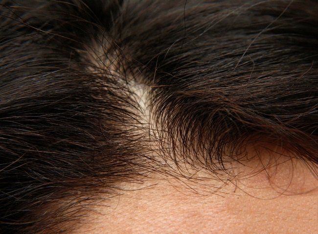 Problemas en el cuero cabelludo: Tipos de alopecia