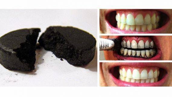Advirten dos riscos de branquear os dentes con carbón activado