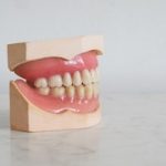 Cómo blanquear los dientes; ¿En casa o en clínica dental?