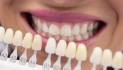 Blanqueamiento dental en agosto sin esperas