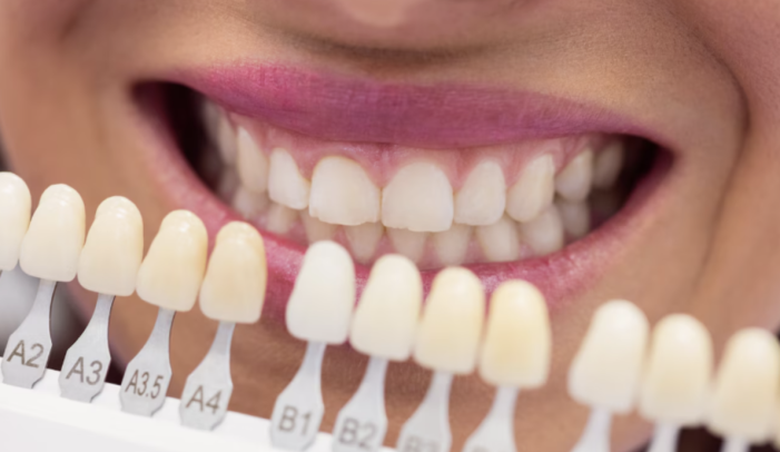 Blanqueamiento dental en agosto sin esperas Blanqueamiento dental en agosto sin esperas